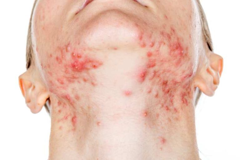 Coșuri pe gât: Cauze și remedii naturiste