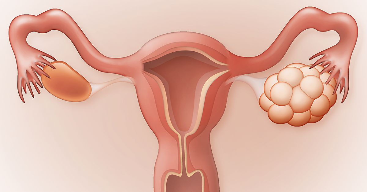 Dieta eficientă pentru ovarele polichistice