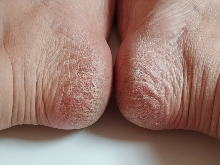 Călcâie crăpate și aspre: Cauze, simptome și remedii eficiente