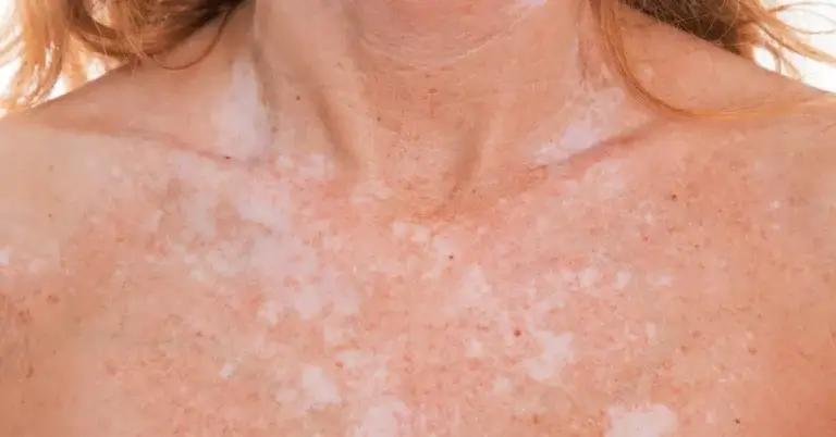 Pete albe pe piele – cauze și tratamente posibile