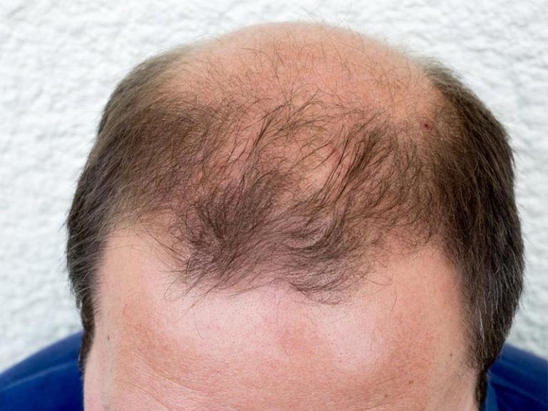 Alopecia (caderea parului) – cauze si tratament