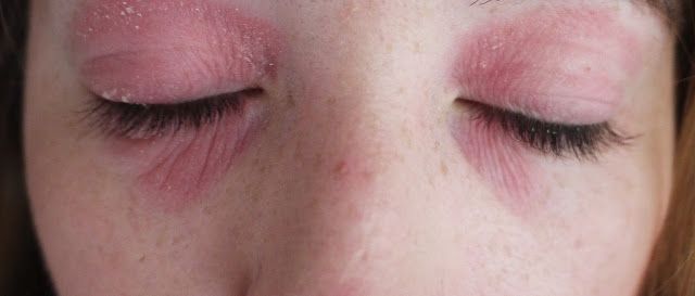 dermatita in jurul ochilor separarea ridurilor pliurilor nazolabiale