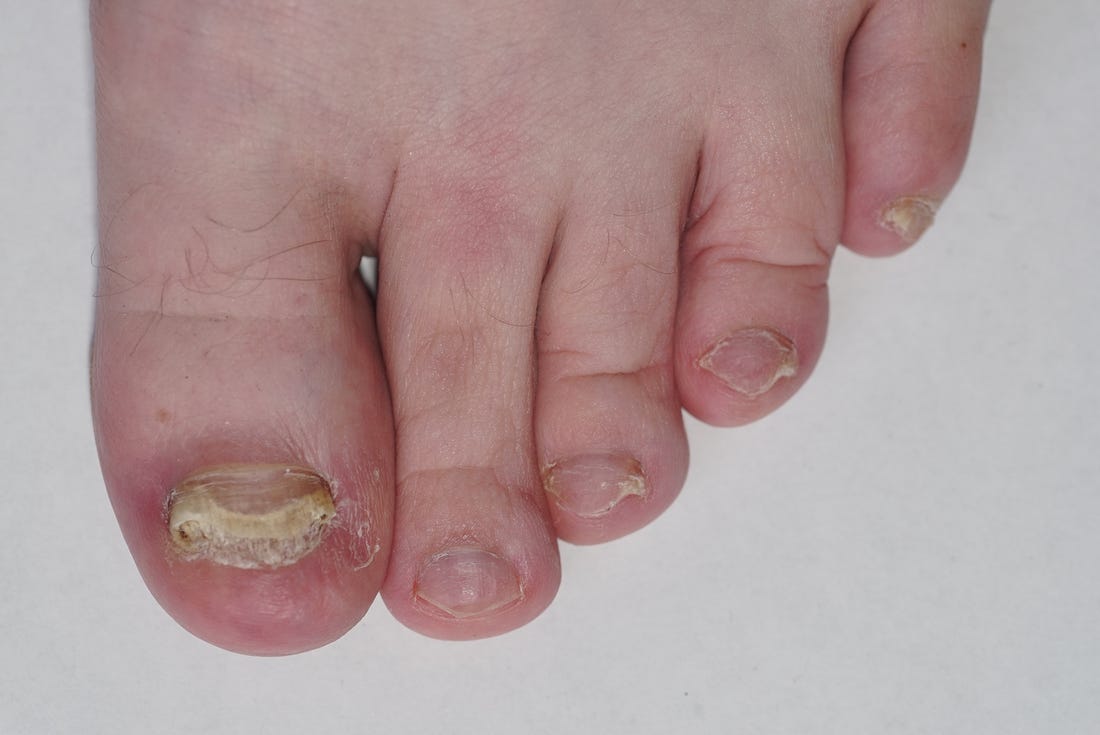 poate ciuperca de toenail provoacă pierderea în greutate