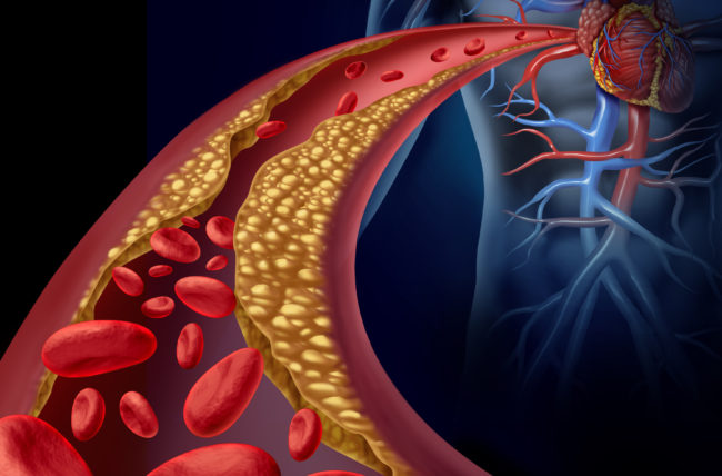 Cardiopatia ischemica - factori de risc