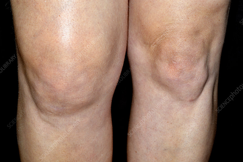 durere în articulația genunchiului tratamentul osteocondrozei cronice a coloanei lombare