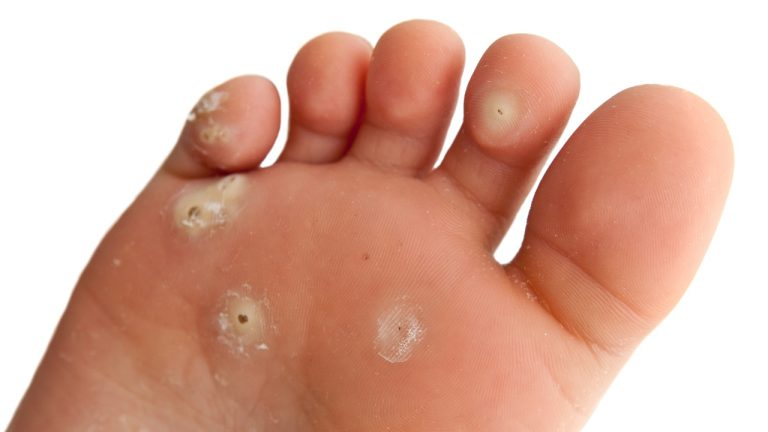 Cum sa scapi de negii plantari cu ajutorul remediilor naturiste