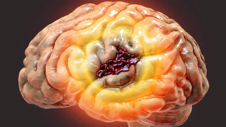 Simptomele accidentului vascular cerebral, cauze si remedii