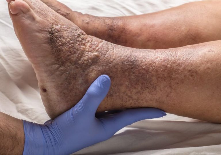 10 semne si simptome ale unui cheag de sange neobisnuit